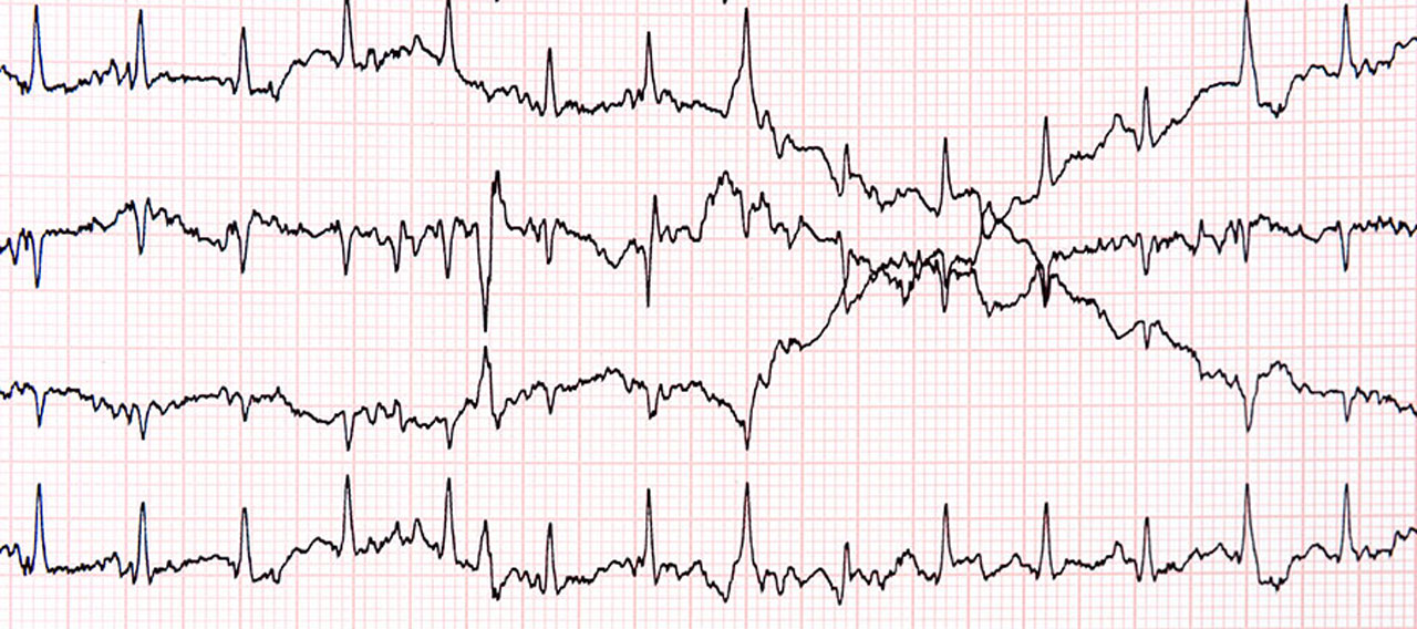 pulse trace