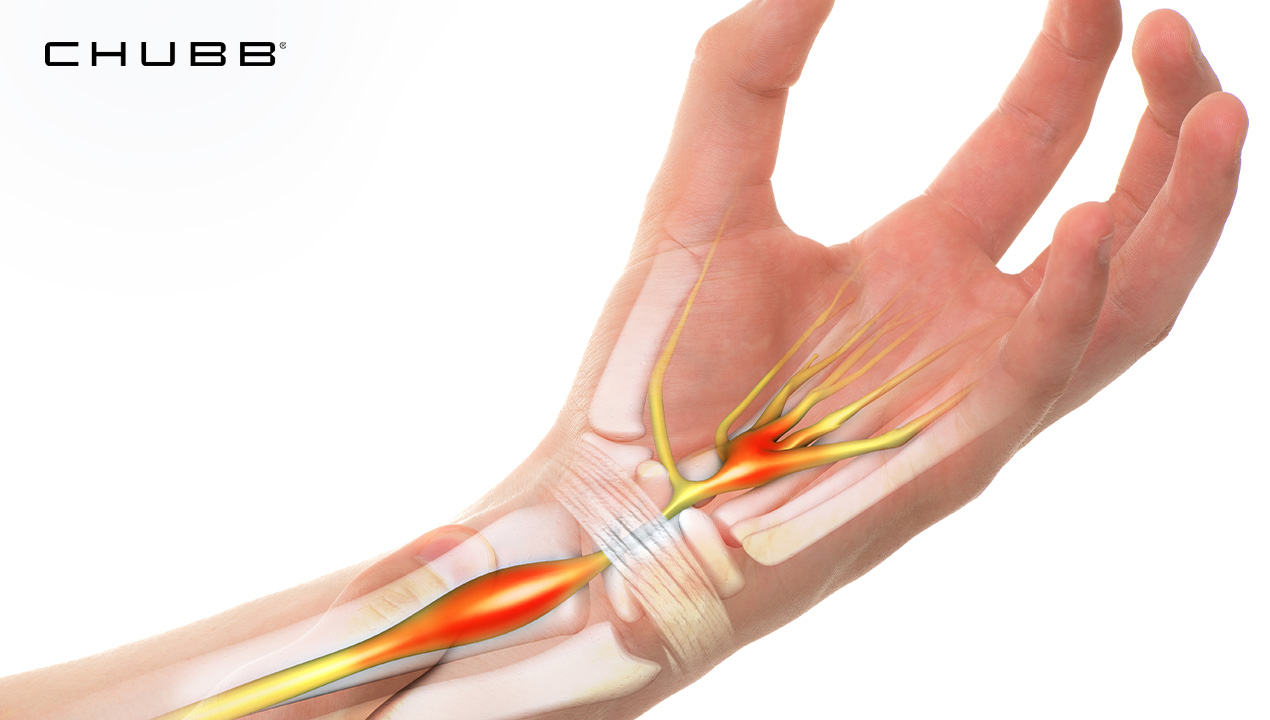 ภาวะการกดทับเส้นประสาท