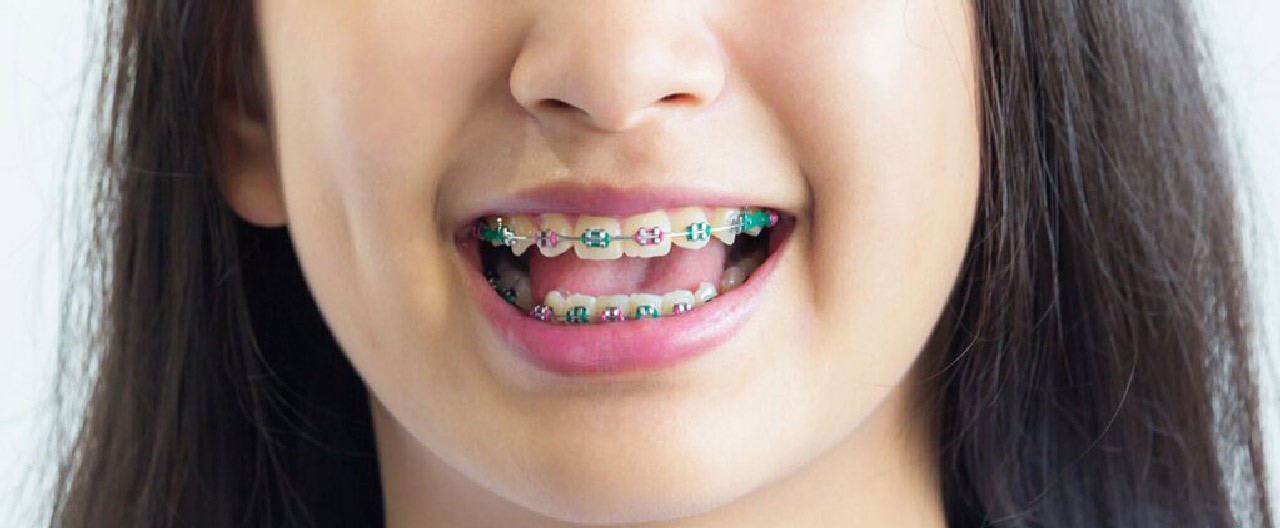 person with braces