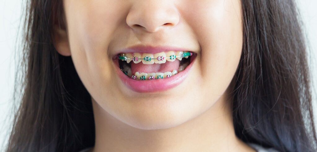 Kapan Anak Saya Benar-Benar Membutuhkan Kawat Gigi?